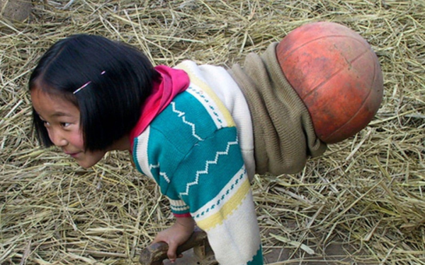 "Basketball Girl" Lost Half Her Body Still Optimistic