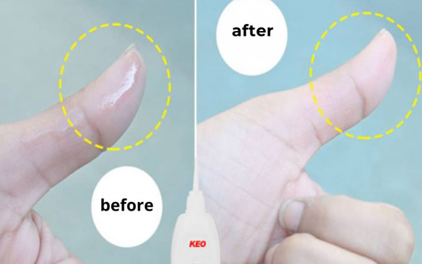 Remove glue from skin quickly